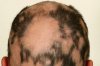VWH-DermNetNZ-Alopecia-02-8594d84014464b3c9d21fae4db954234.jpg